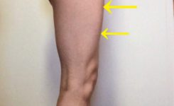 前ももの張りのラインを示す矢印の入った写真