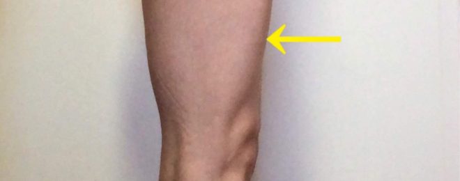 前ももの張りのラインを示す矢印の入った写真