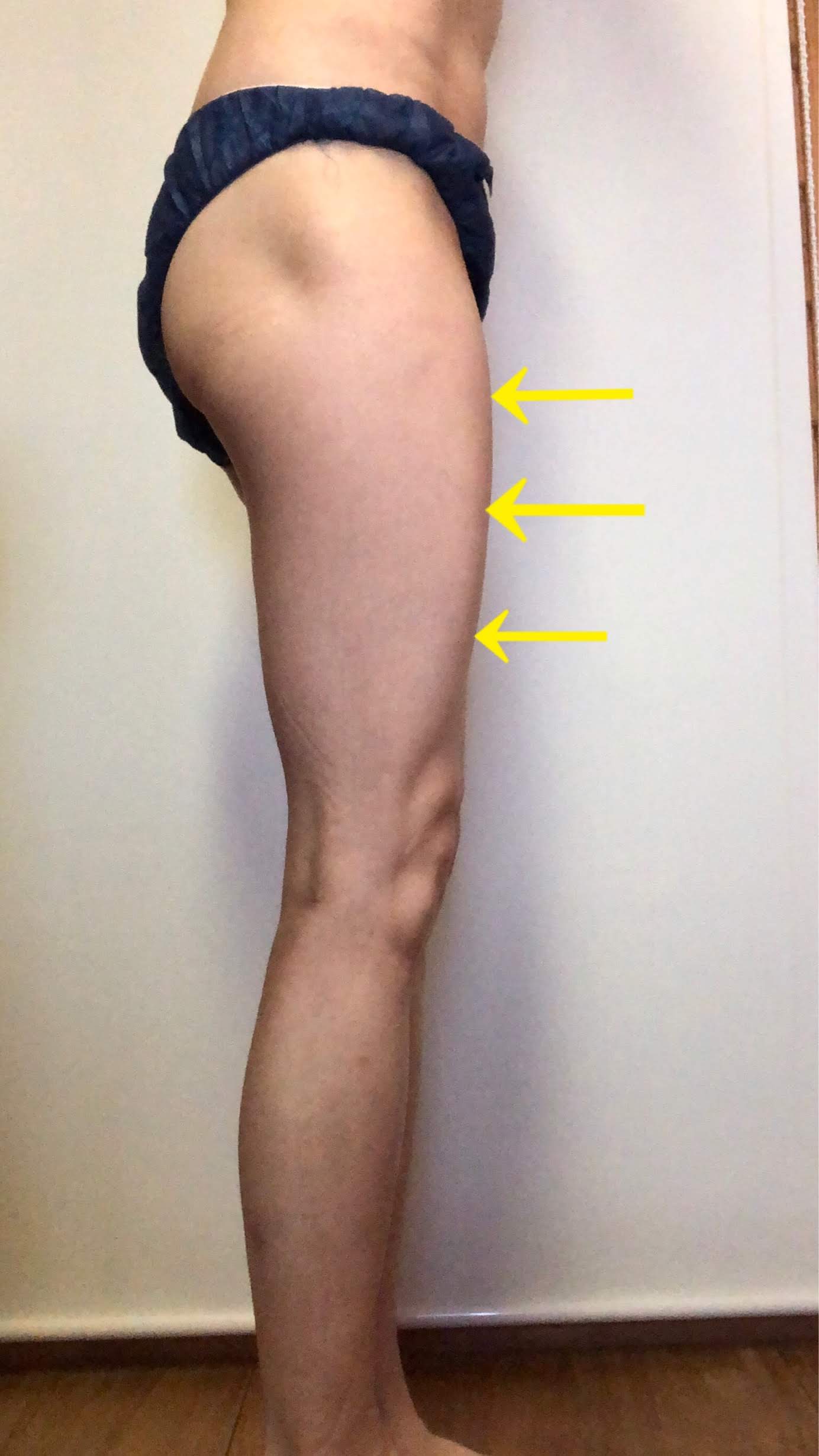 前ももの張りのラインを示す矢印の入った写真